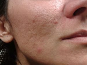 fractional laser / πριν - Θεσσαλονίκη